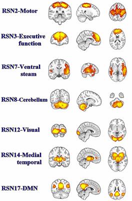 Sex Differences in Abnormal Intrinsic Functional Connectivity After Acute Mild Traumatic Brain Injury